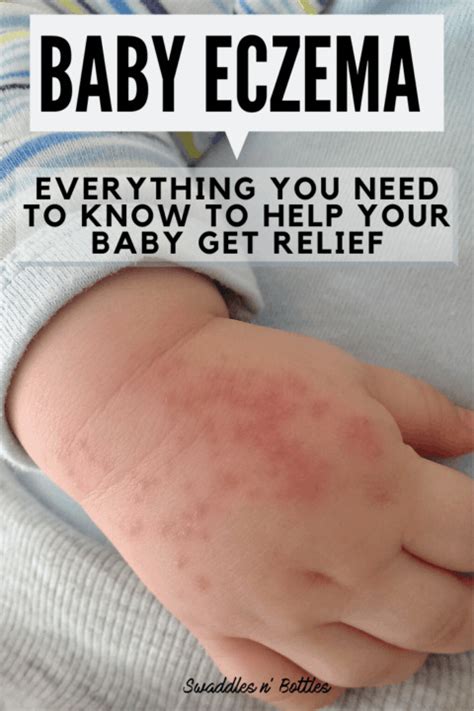 What Causes Eczema For Babies